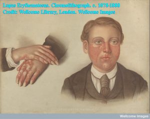 Lupus Erythematosus. Chromolithograph. c. 1878-1888 Credit: Wellcome Library, London. Wellcome Images